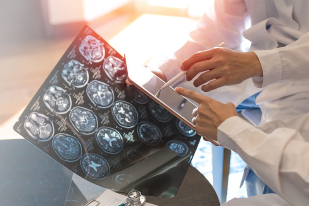 Bulanık Görme ve Güçsüzlük MS Belirtisi Olabilir