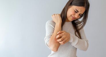 Soğuk Hava ve Rüzgar Egzamayı Tetikliyor!