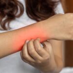 Uyuz Hastalığı Nedir? Uyuz Hastalığı Neden Olur?