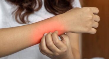 Uyuz Hastalığı Nedir? Uyuz Hastalığı Neden Olur?