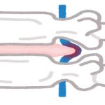 Bel Fıtığı Tedavisinde Yeni Yaklaşımlar: Shi Manipülasyonu ve Daoyin Terapisi