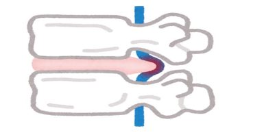 Bel Fıtığı Tedavisinde Yeni Yaklaşımlar: Shi Manipülasyonu ve Daoyin Terapisi