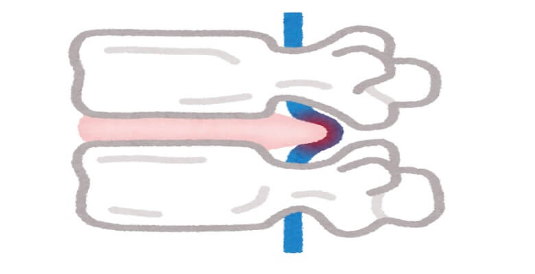 Bel Fıtığı Tedavisinde Yeni Yaklaşımlar: Shi Manipülasyonu ve Daoyin Terapisi