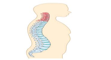 Boyun Fıtığı ve Ameliyat Yöntemleri: ACDF ve PCF Karşılaştırması