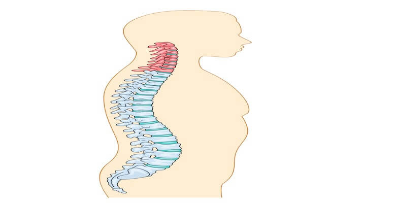 Boyun Fıtığı ve Ameliyat Yöntemleri: ACDF ve PCF Karşılaştırması